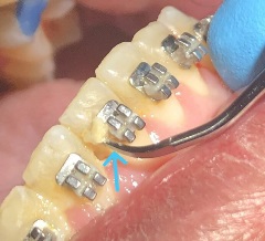 Nodal point nodal point